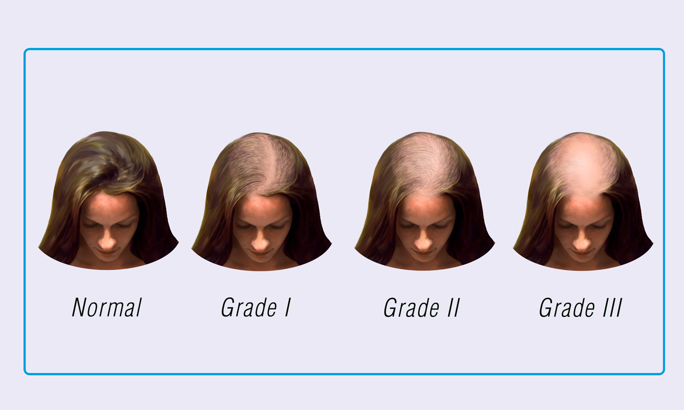 Ludwig's Scale for Women - Use Ludwigs Scale Chart For Hair Loss