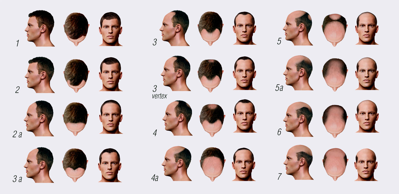 TCHR-Norwood-Scale