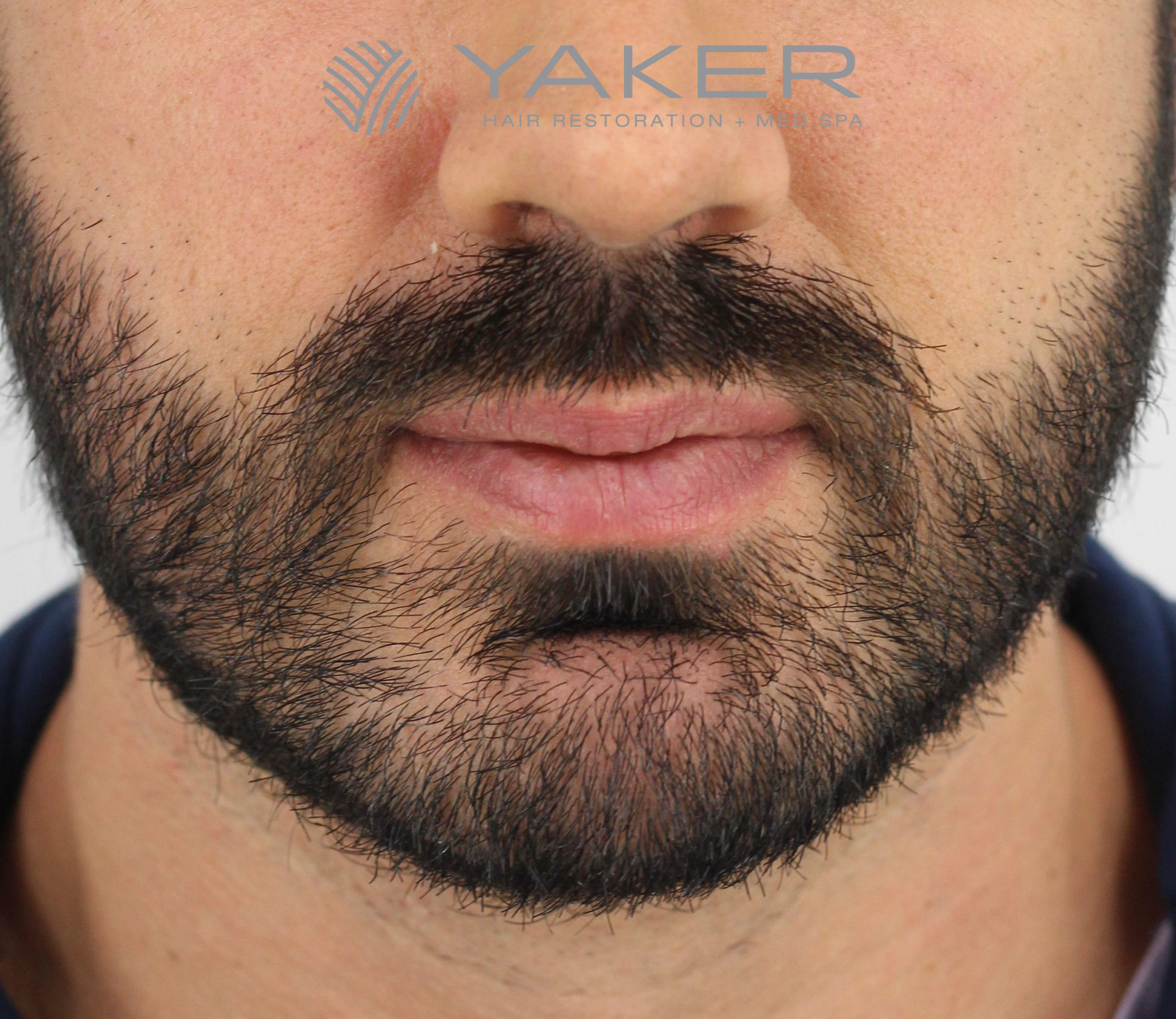 Beard Transplant LP Yaker Hair Restoration Med Spa