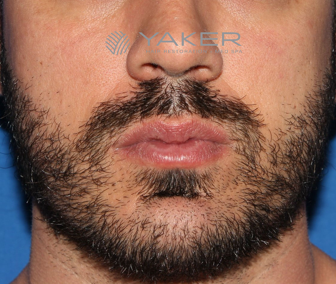 Beard Transplant Cost in Bangalore  Beard Transplant in Bangalore   Moustaches Hair  Curlsncurves