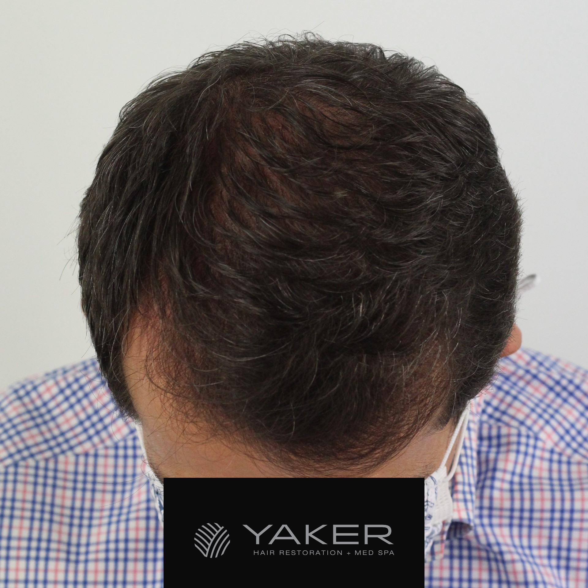 Male Hair Transplant