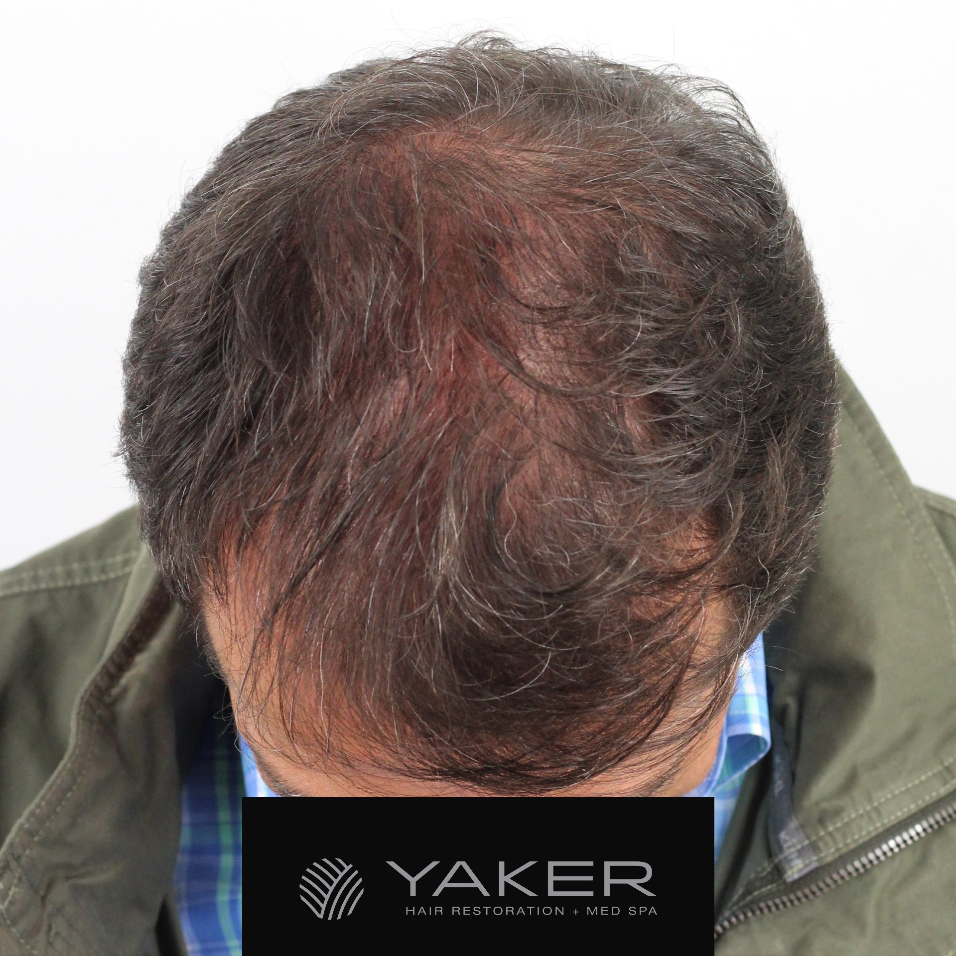 Male Hair Scalp