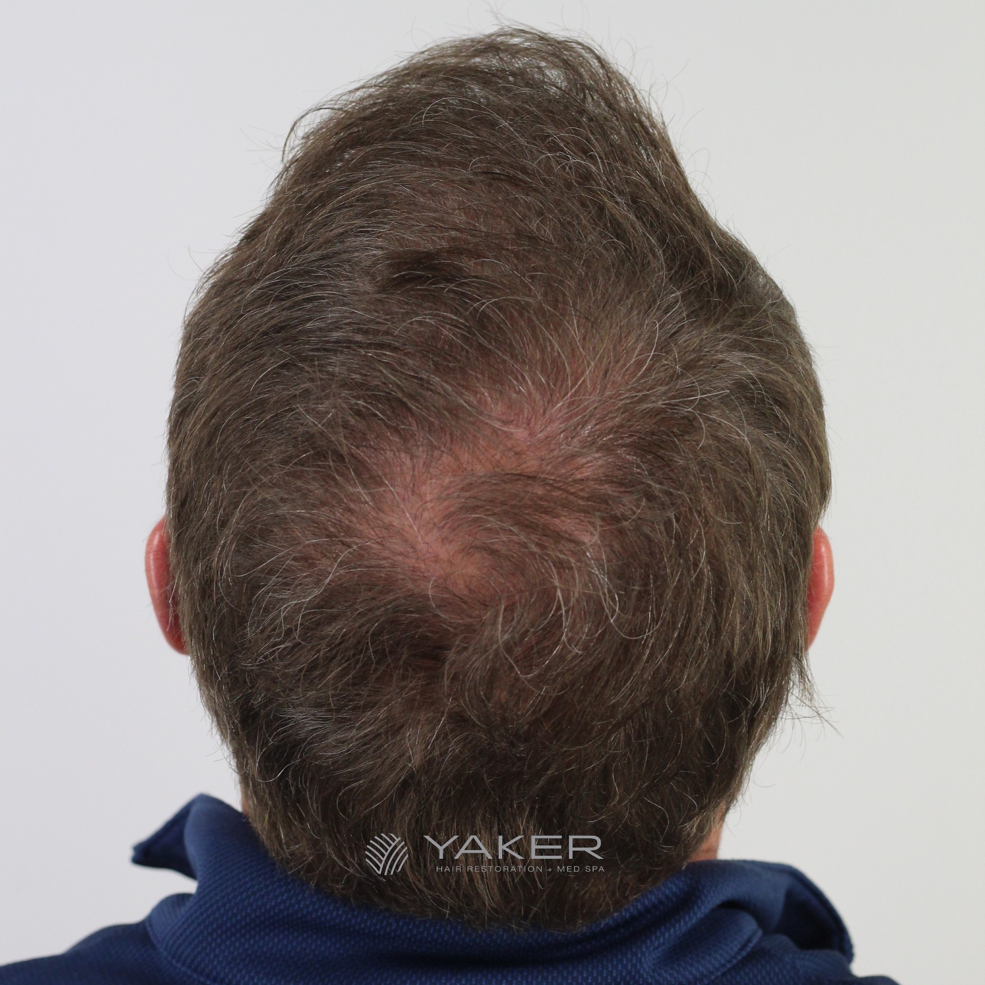 Male Hair Transplant