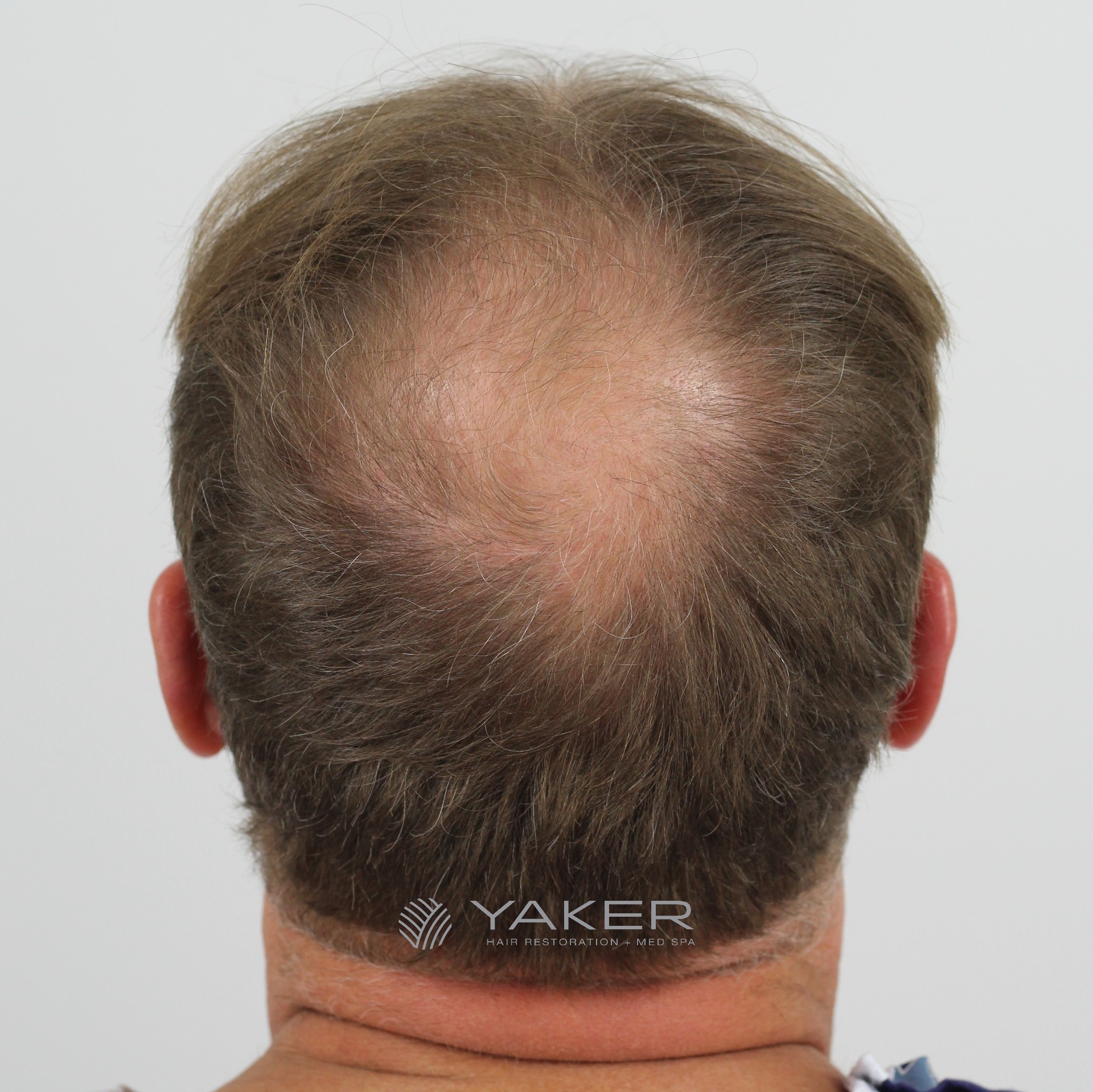 Male Hair Loss