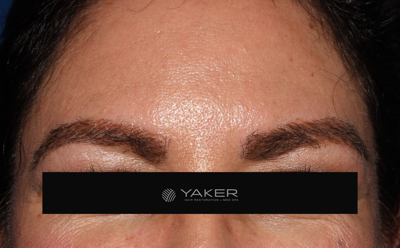 Eyebrow Transplant LP - Yaker Hair Restoration + Med Spa