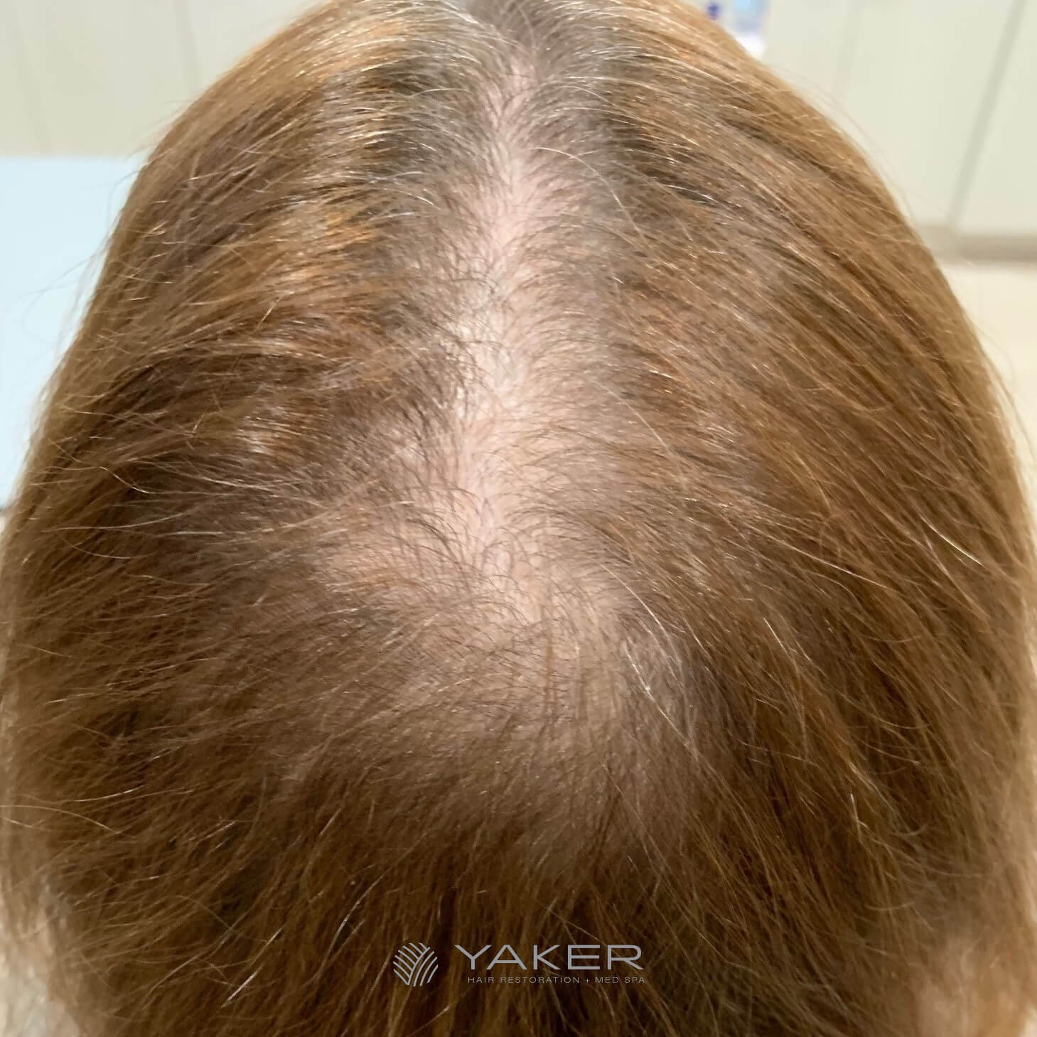 Topical Finasteride