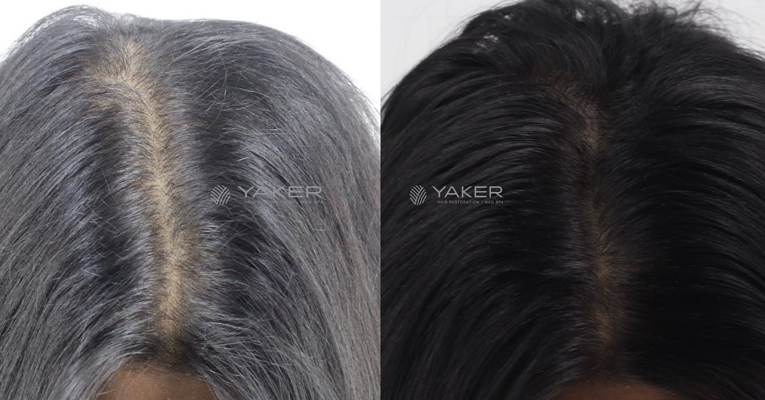 Treatments for Hair Loss in Women | Yaker Hair Restoration + Med Spa